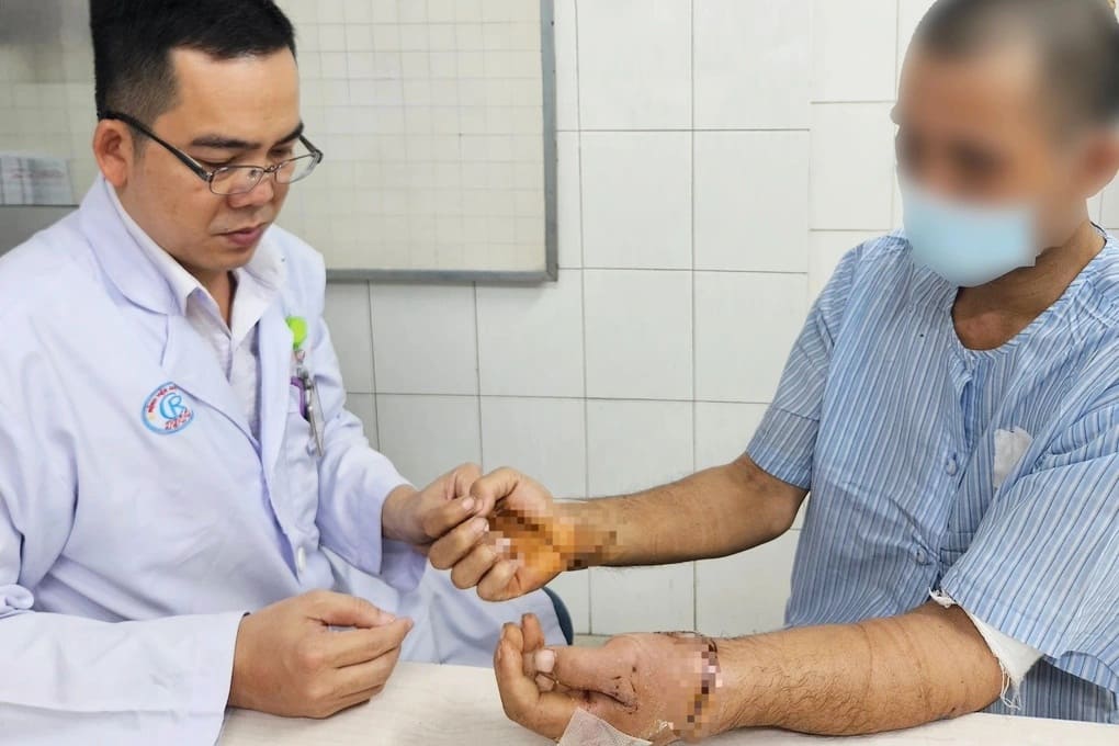 Ca phẫu thuật nối lại bàn tay phức tạp bởi ê-kíp vi phẫu