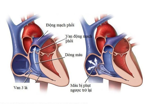 Bệnh hở van tim 3 lá có nguy hiểm không