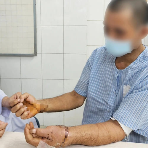 Người đàn ông 40 tuổi bị chém đứt cả 2 bàn tay sau ẩu đả với hàng xóm
