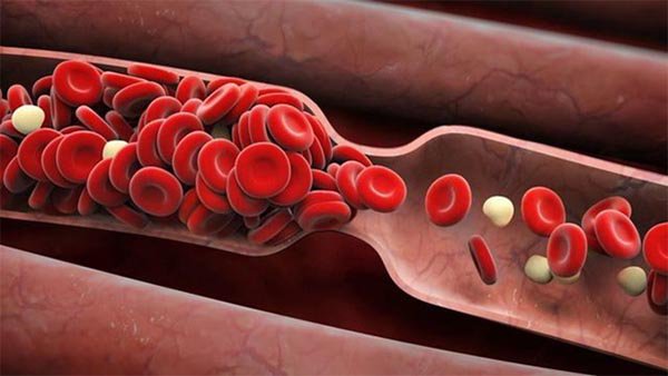 Triệu chứng và nguyên nhân của lưu thông máu kém